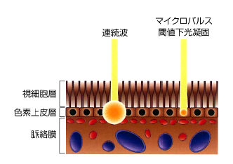 マイクロパルスレーザー